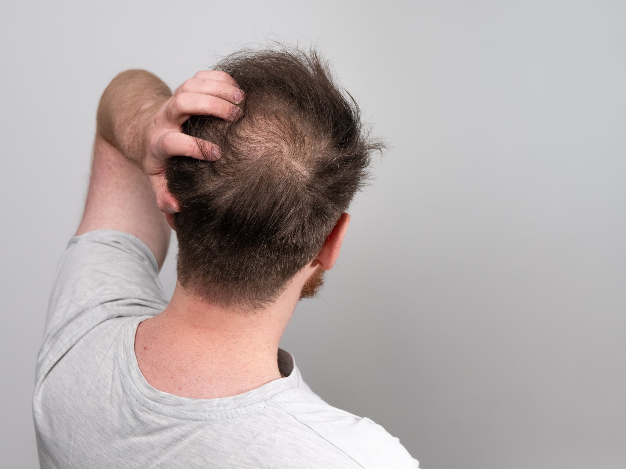 Haarausfall 3 Formen, 7 Ursachen + 9 Maßnahmen bei Alopezie